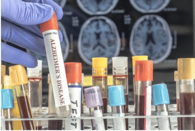 Blood test shows great promise in the diagnosis of Alzheimer's disease