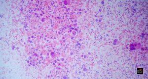 Ground-Breaking Treatment Aims To Stop Cancer From Returning